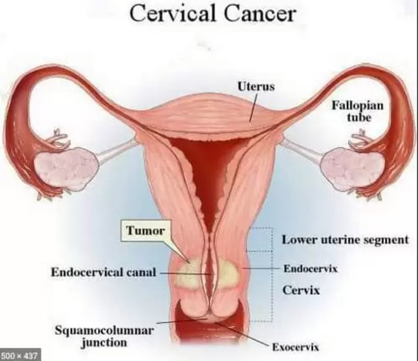 सर्वाइकल कैंसर क्यों होता है